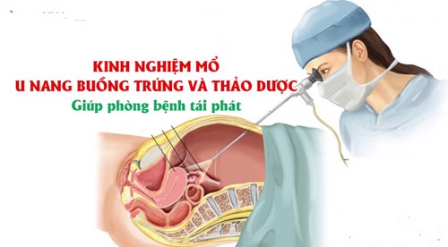 Kinh nghiệm mổ u nang buồng trứng và thảo dược giúp phòng bệnh tái phát